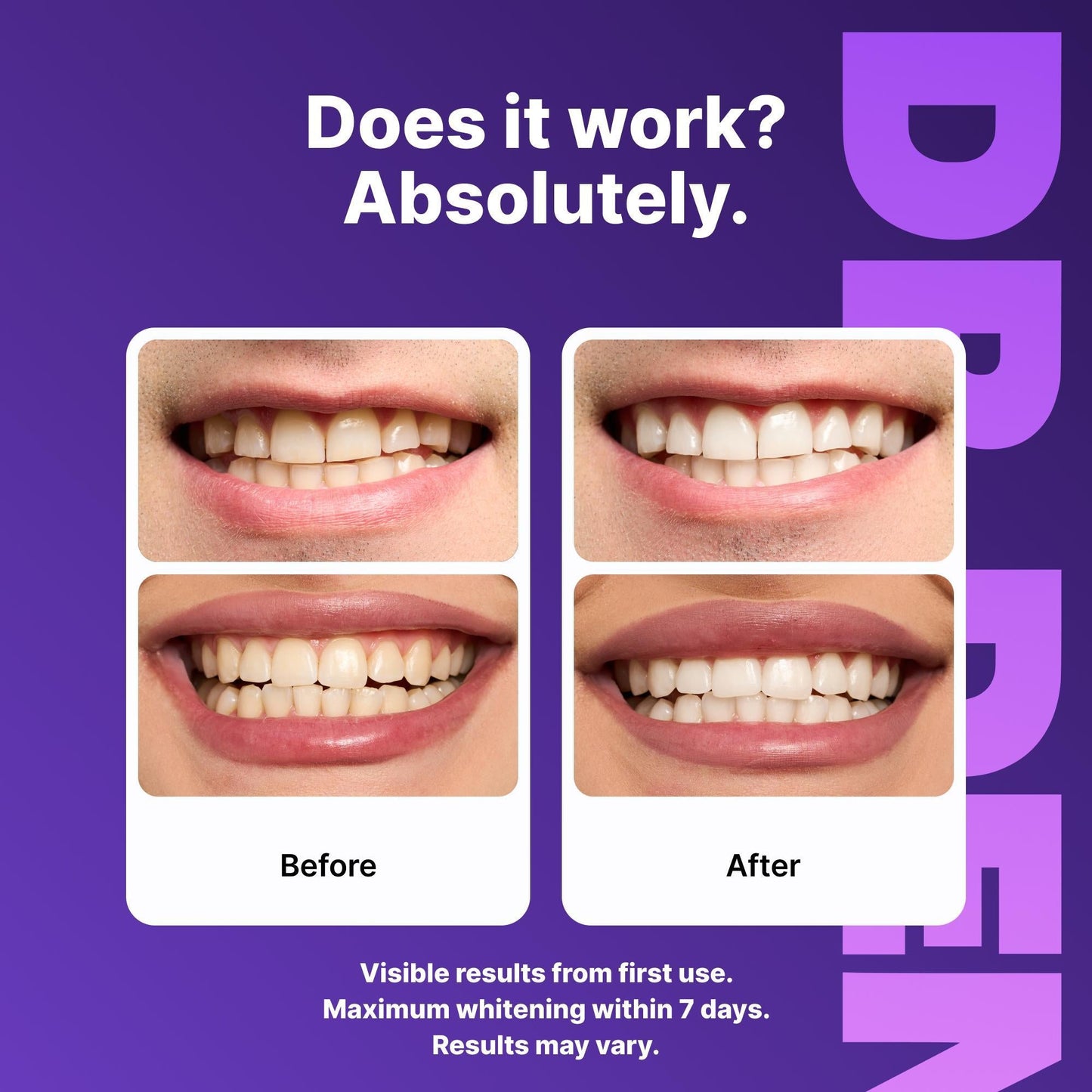 🔥DRDENT Purple Teeth Whitening Strips - 7/21 Whitening Sessions - Safe for Enamel - Non Sensitive Teeth Whitening - Peroxide-Free🍃-LGZ